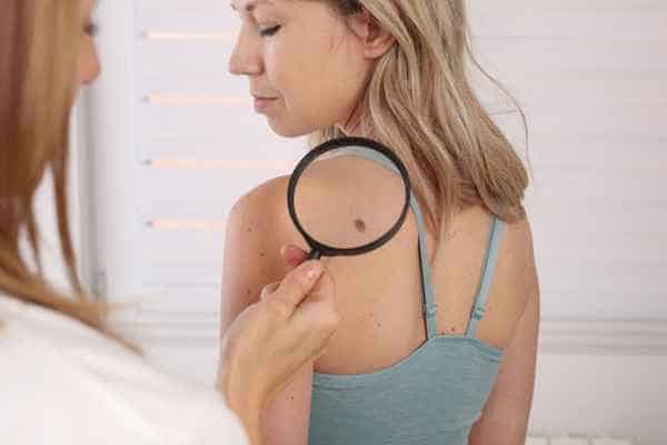 What Are Traditional Skin Lesion Removal Methods Marlborough?