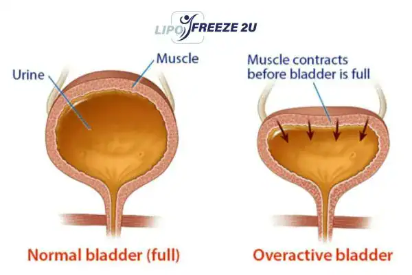 diagram of overactive bladder treatment Marlborough