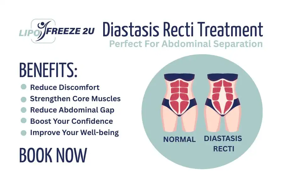 How Long Will It Take to See Improvements in Diastasis Recti Marlborough