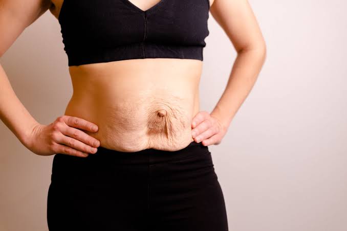 Is Surgery Really the Only Way to Repair Diastasis Recti Marlborough?