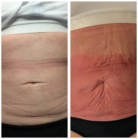 How Does RF Microneedling Improve Crepey, Thin and Uneven Skin Texture Marlborough?