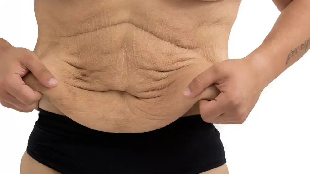 RF Microneedling for Loose Skin: How Can It Help Tighten and Reshape the Skin Marlborough?